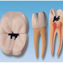 右侧***颗磨牙蛀牙模型YR-L1002